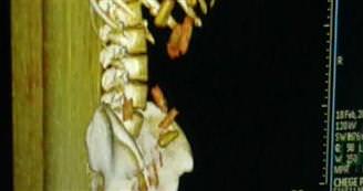 Midesinde 99 kapsül kokain ç�kt�