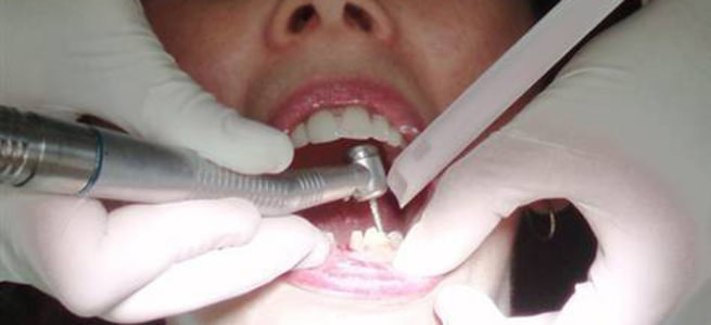 Çürük diş kanser riskini azaltıyor
