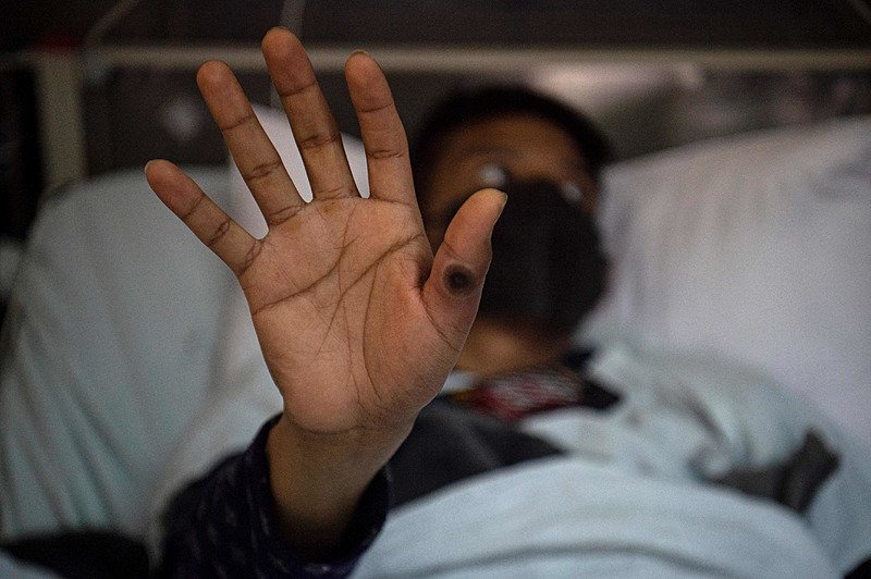 Monkeypox MPOX Guide: Here are transmission routes, symptoms, and treatment