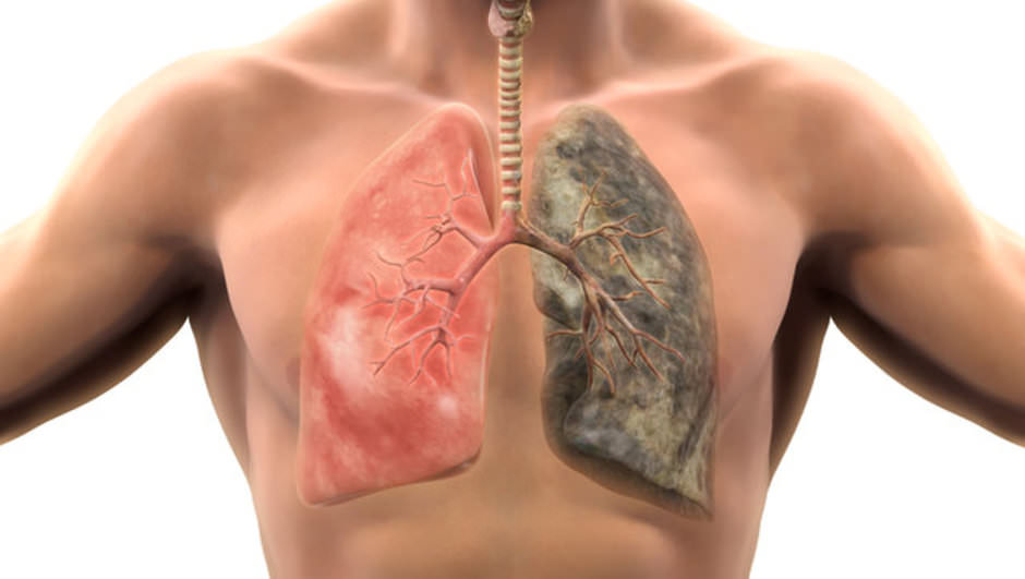 Akciğer hastalarının tedavisinde yeni umut